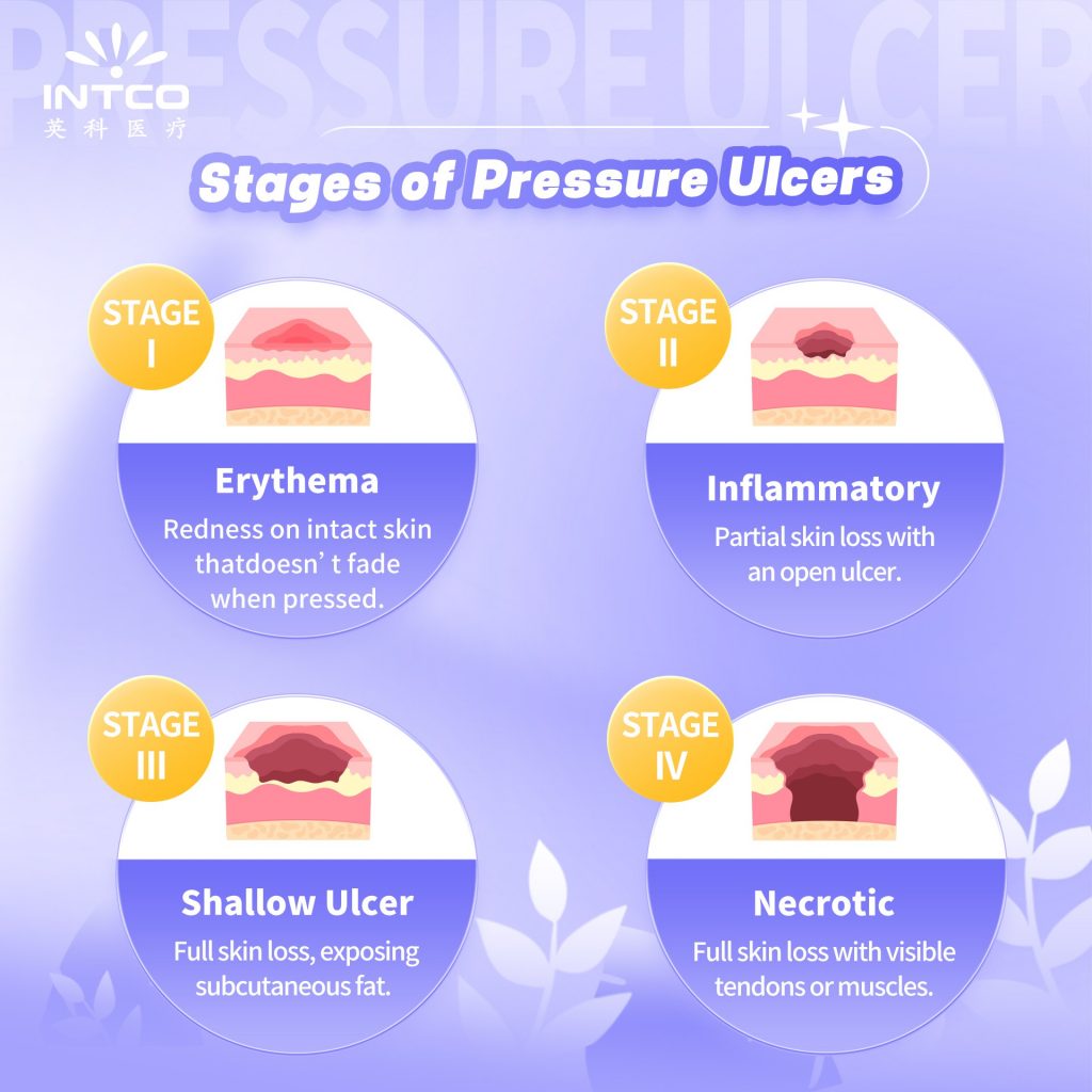 Stages of Pressure Ulcers